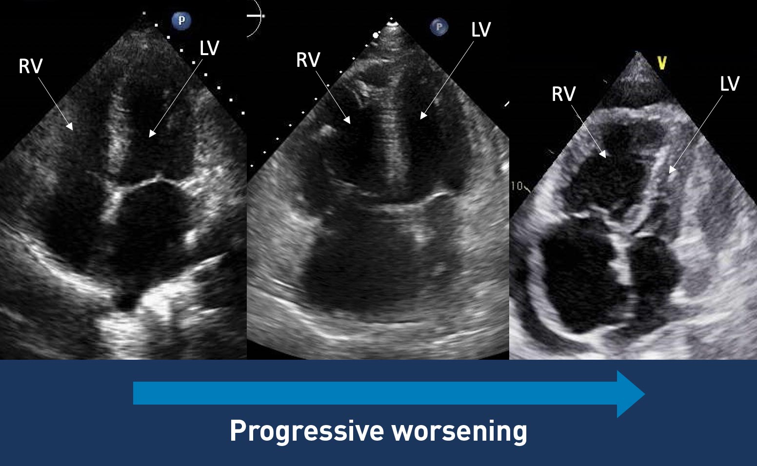 Echo of the heart that the progressive dilation of the RV and RA in PAH