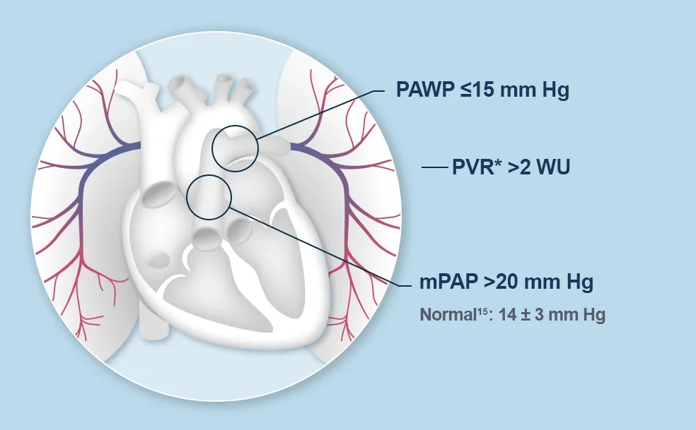 Illustration of right heart catheterization definitive diagnosis of WHO Group 1 PAH