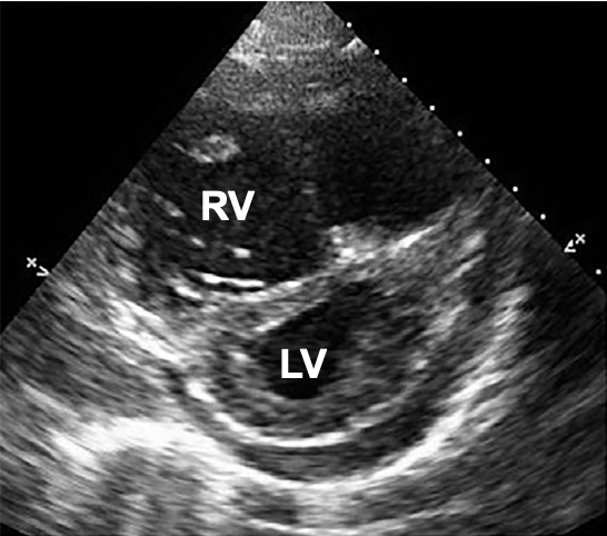 Interventricular septum echo view