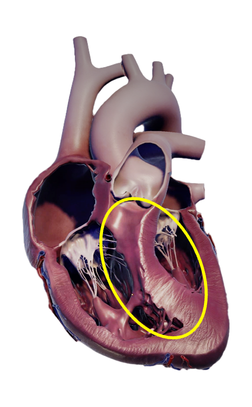Abnormal interventricular septum anatomy