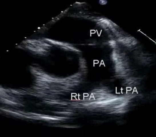 Pulmonary artery echo view