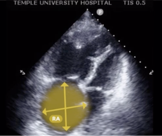 Right atrium echo view