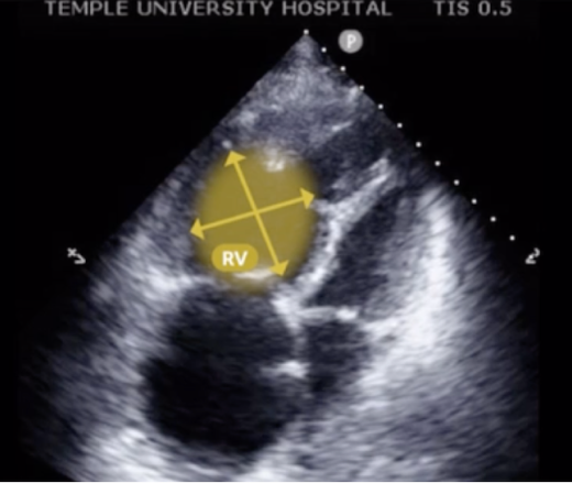 Right ventricle echo view