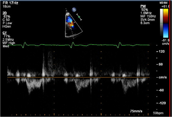 RVOT echo image