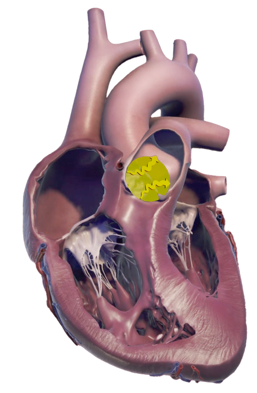 RVOT anatomy diagram