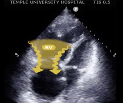 TRV echo view