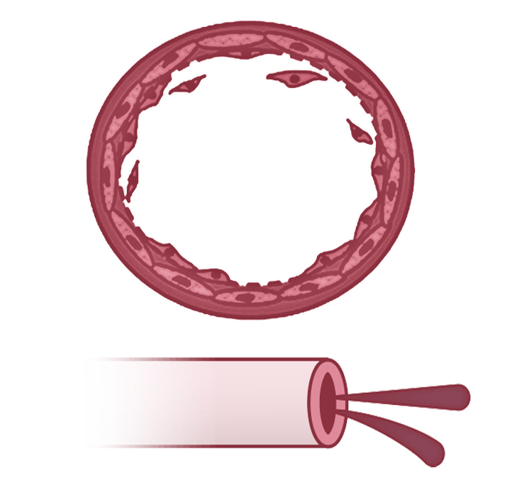 Illustration of a compensation pulmonary artery