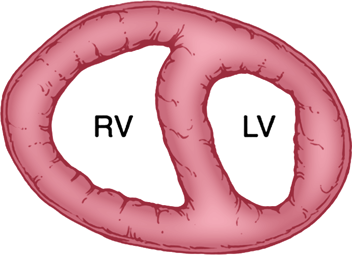Illustration of a compensation right ventricle