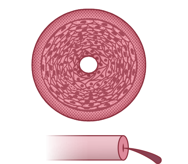 Illustration of a failure in pulmonary arteries