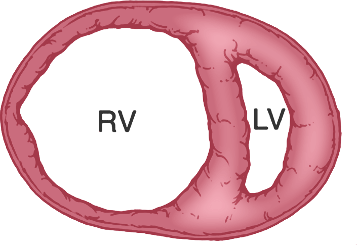 Illustration of failure in the right ventricle