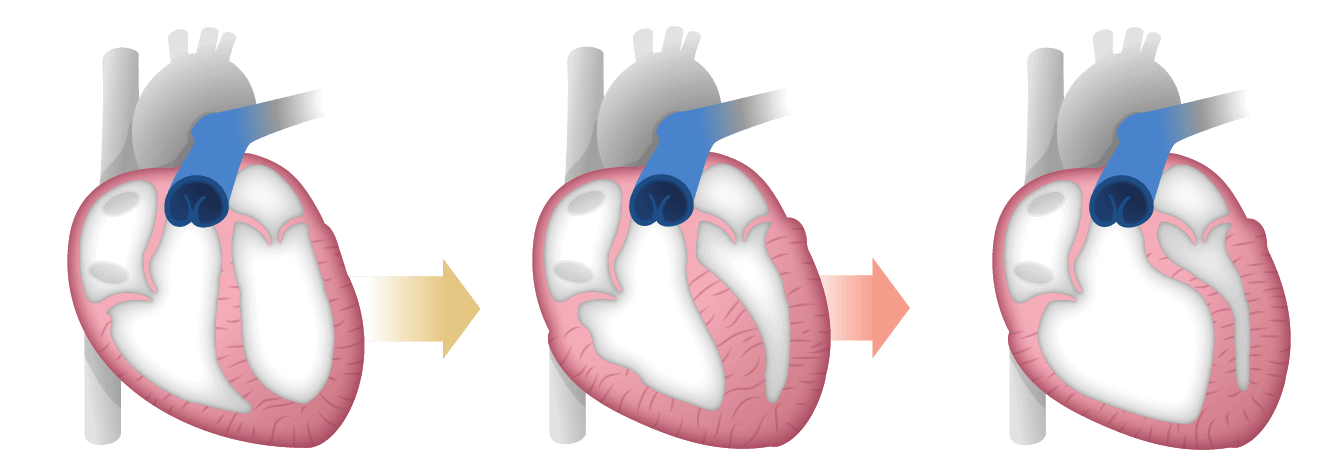 A closer look at a heart as it goes through RV dysfunction