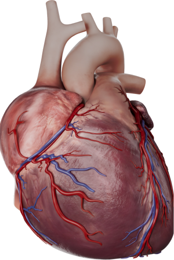 PAH heart showing right ventricular enlargement