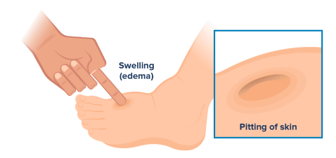 Visual showing what some signs of edema look like on a PAH patient: swollen ankles and pitting