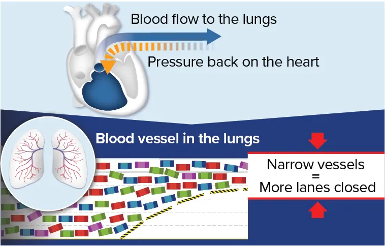 Blood flow through narrow PAH blood vessels