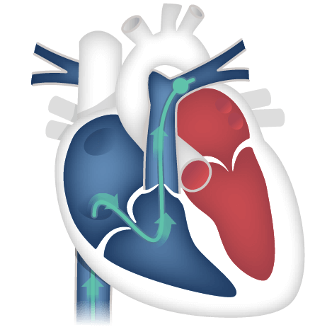 Right heart catheterization