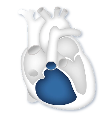 A normal heart compared to a heart with enlarged right side under strain due to PAH