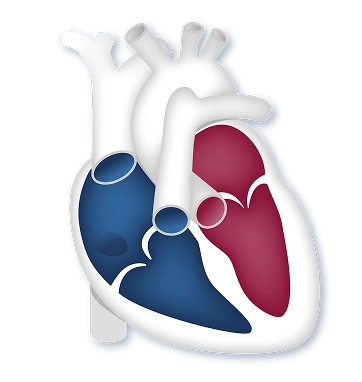 A normal heart compared to a heart with enlarged right side under strain due to PAH