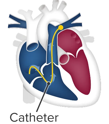 Catheter in the right side of the heart