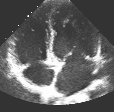 Image of an echocardiogram showing an enlarged right side of the heart
