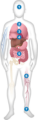 Body illustration showing non specific clinical characteristics, labeled by number based on the criteria evaluated in the diagnosis of PAH