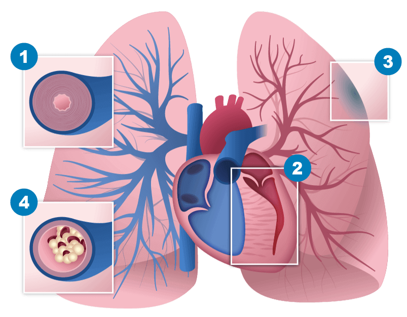 Heart and lung image showing how WHO categorizes PH into 5 groups, along with the effects and location of PAH Group 1, a rare subset