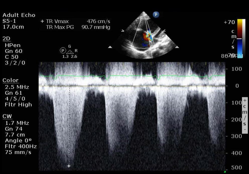 An apical 4-chamber view of an echo showing right dilation from PAH