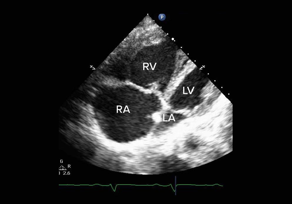 A doppler view of systolic pulmonary artery pressure with right dilation from PAH
