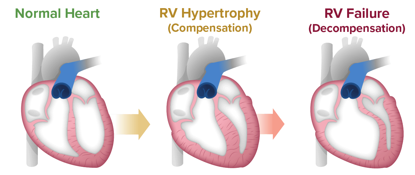 A closer look at a heart as it goes through rv dysfunction