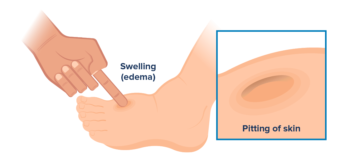 Visual showing what some signs of edema look like on a PAH patient: swollen ankles and pitting