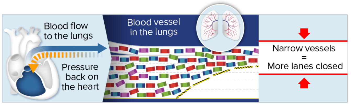 Blood flow through narrow PAH blood vessels